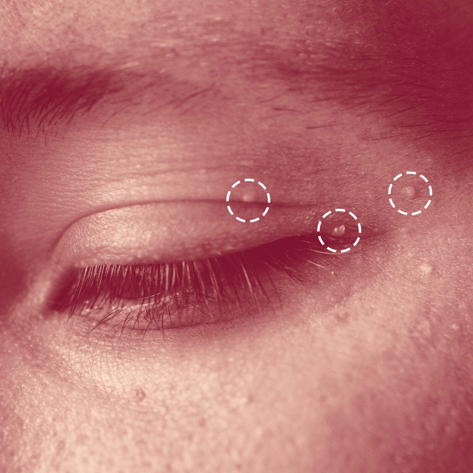 How to Get Rid of Milia, Those Pesky, Unpoppable White Bumps