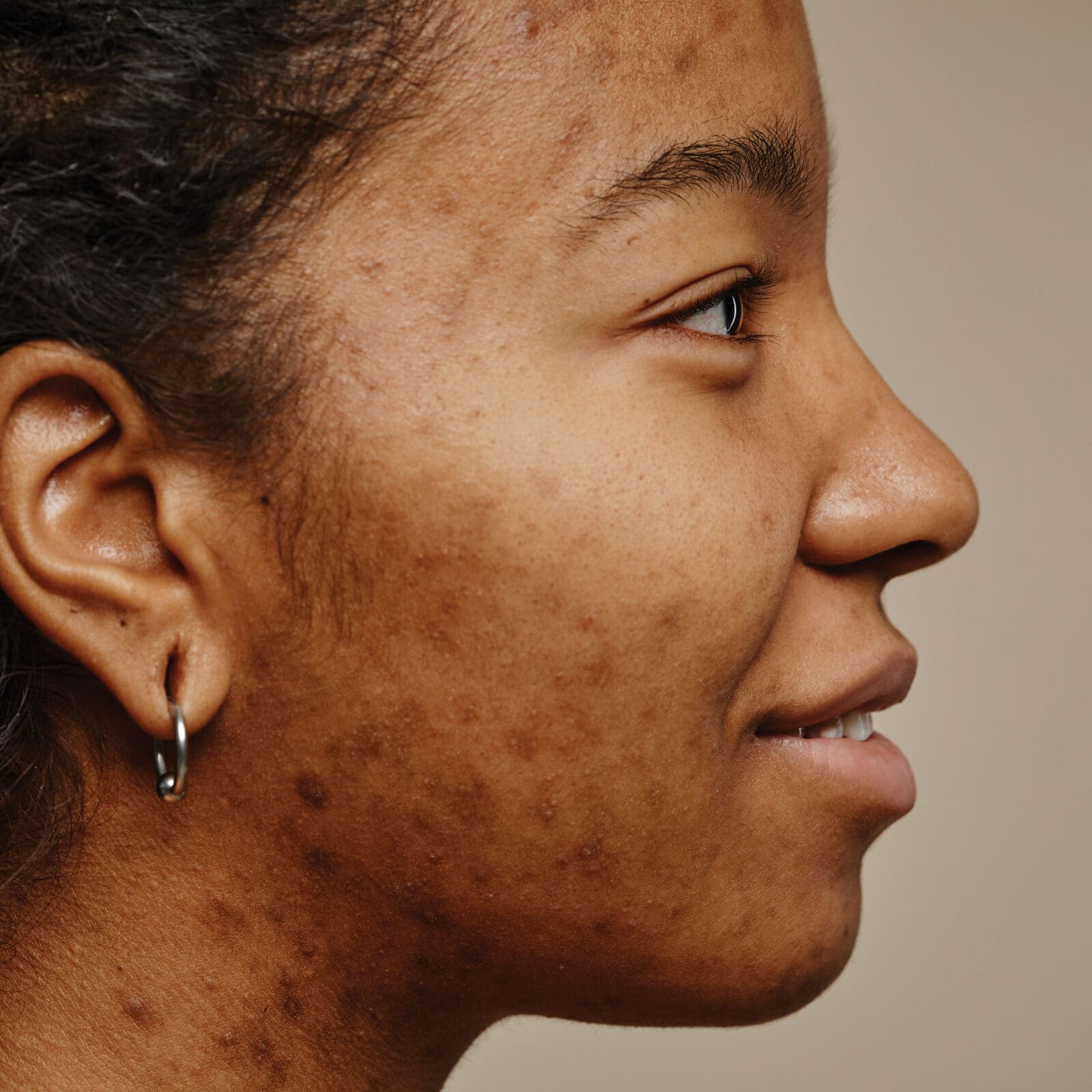 How to Treat Acne and Dark Spots on Morena Skin