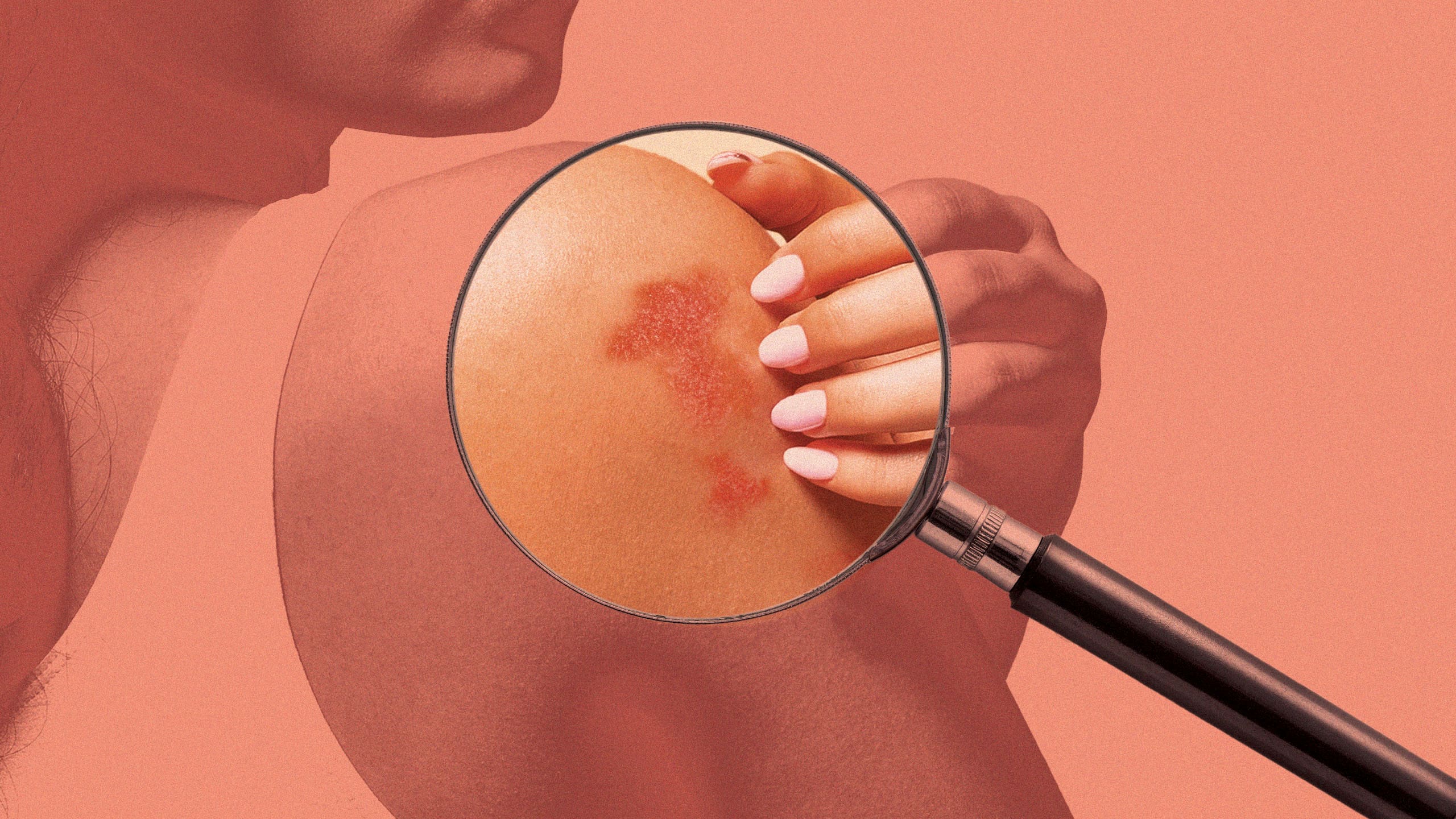 Psoriasis or Eczema: Similarities, Differences, and Treatment