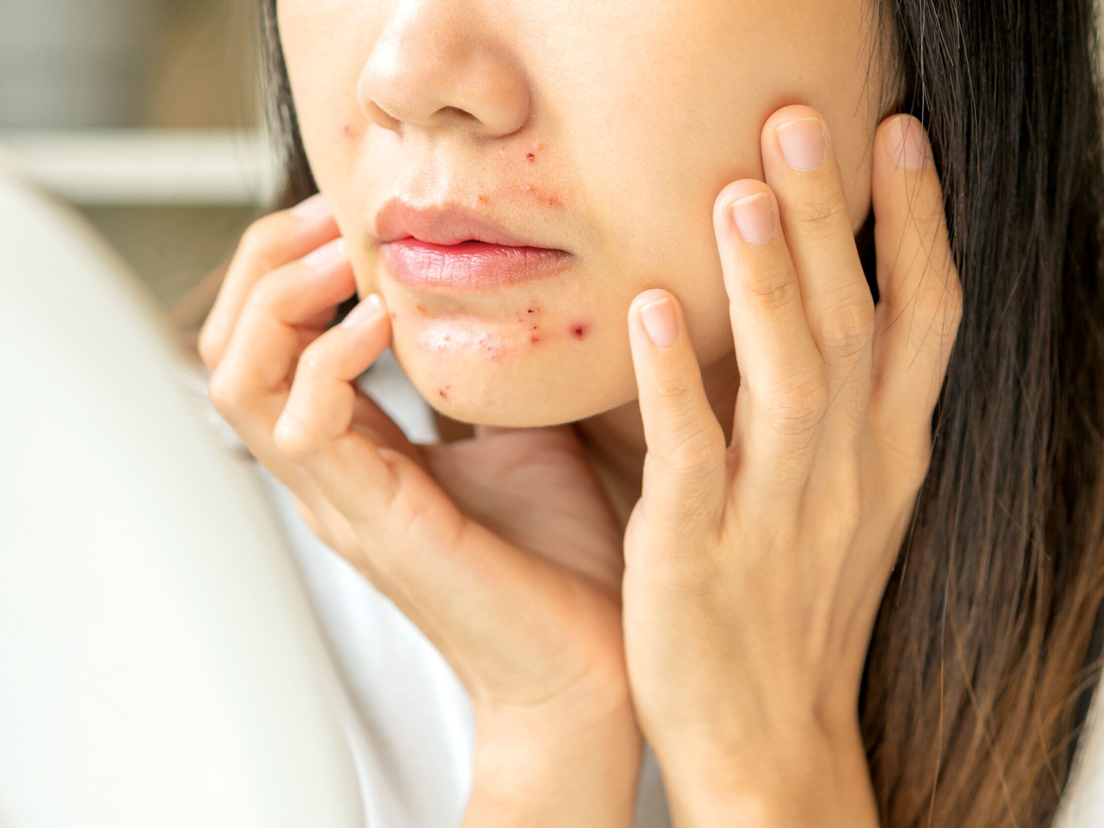 Breaking-Out-in-Your-40s-After-Years-of-