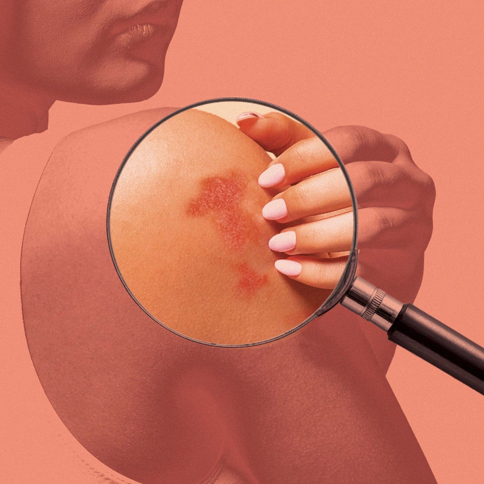 Psoriasis or Eczema: Similarities, Differences, and Treatment