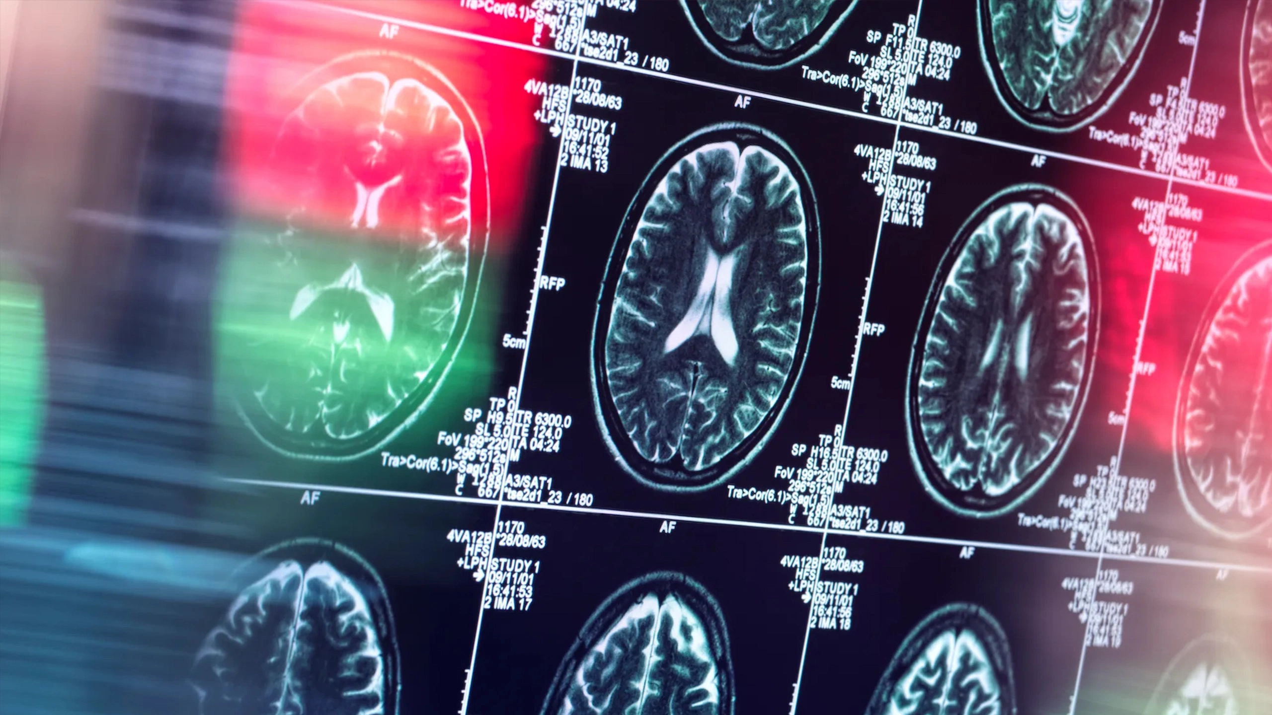 Brain Scans Are Becoming an Increasingly Popular Tool for Dealing With Trauma